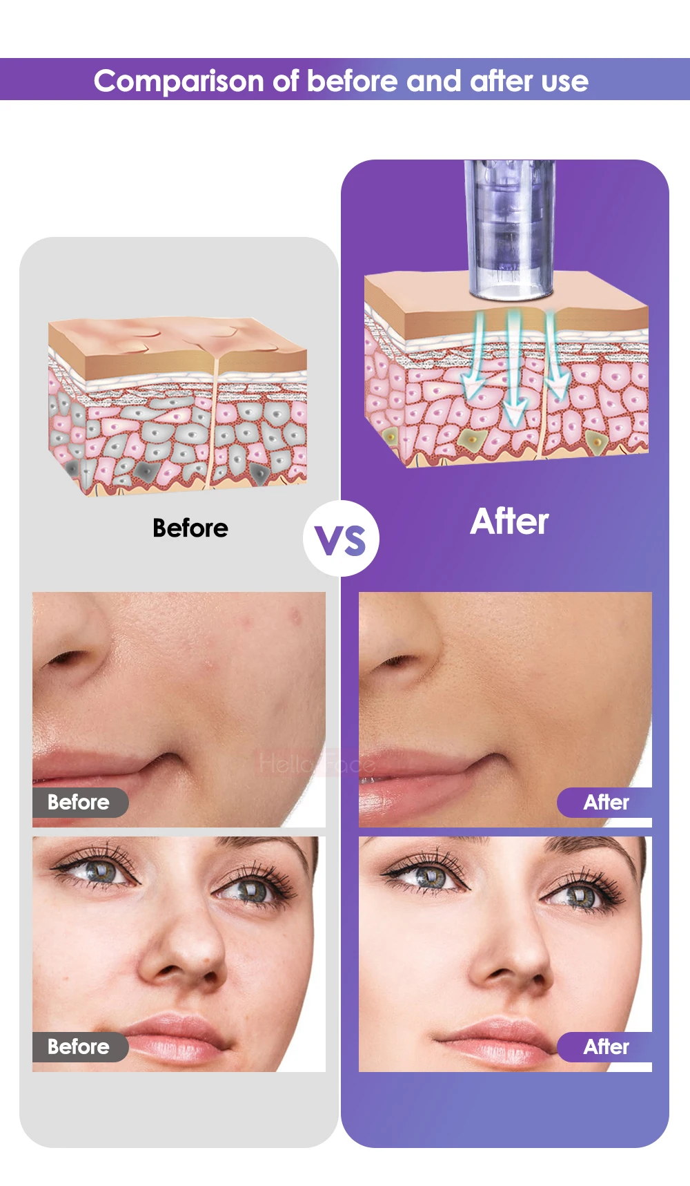 Mesotherapy Microneedle Pen